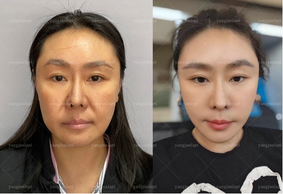 北京四季青橙杨俊拉皮性价比高吗？价格、效果、时效综合对比